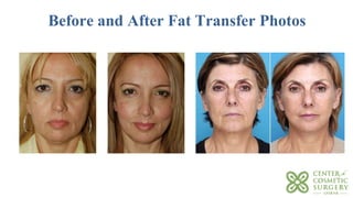 Before and After Fat Transfer Photos
 