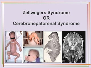Zellwegers Syndrome
OR
Cerebrohepatorenal Syndrome
 