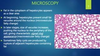 MICROSCOPY
 Fat in the cytoplasm of hepatocytes appears
as a clear area
 At beginning, hepatocytes present small fat
vacuoles around the nucleus (microvesicular
fatty change)
 In later stages, size of vacuoles increases,
pushing the nucleus to the periphery of the
cell, giving characteristic signet ring
appearance (macrovesicular fatty change)
 Sometimes fatty cysts are produced by
rupture of adjacent hepatocytes containing
fat
7
 