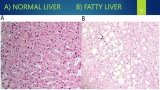 A) NORMAL LIVER B) FATTY LIVER 9
 