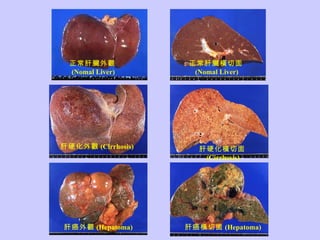 正常肝臟外觀 (Nomal Liver) 正常肝臟橫切面 (Nomal Liver) 肝硬化外觀 (Cirrhosis) 肝硬化橫切面 (Cirrhosis) 肝癌外觀 (Hepatoma) 肝癌橫切面 (Hepatoma) 