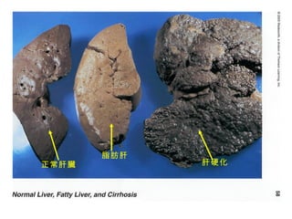 脂肪肝 正常肝臟 肝硬化 