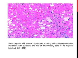 Steatohepatitis with several hepatocytes showing ballooning degeneration
intermixed with steatosis and foci of inflammatory cells in the hepatic
lobules (H&E, ×200).
 