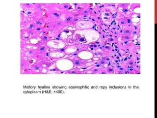Mallory hyaline showing eosinophilic and ropy inclusions in the
cytoplasm (H&E, ×400).
 