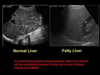 Normal Liver Fatty Liver To avoid false-positive interpretations, fatty liver should not be considered present if only one or two of these criteria are fulfilled 