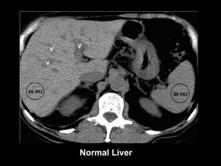Normal Liver 