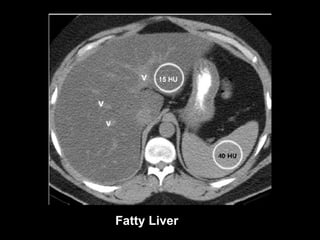 Fatty Liver 