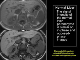 Normal Liver The signal intensity of the normal liver parenchyma is similar on in-phase and opposed-phase images Chemical shift gradient-echo(GRE) imaging with  in-phase and opposed-phase 
