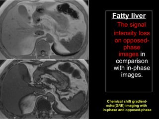 Fatty liver The signal intensity   loss on opposed-phase images  in comparison with in-phase images. Chemical shift gradient-echo(GRE) imaging with  in-phase and opposed-phase 