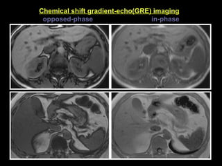Chemical shift gradient-echo(GRE) imaging     opposed-phase  in-phase 