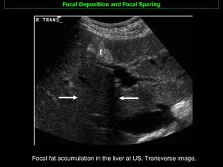 Focal Deposition and Focal Sparing Focal fat accumulation in the liver at US. Transverse image. 