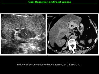 Focal Deposition and Focal Sparing Diffuse fat accumulation with focal sparing at US and CT.  