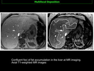 Multifocal Deposition Confluent foci of fat accumulation in the liver at MR imaging. Axial T1-weighted MR images 
