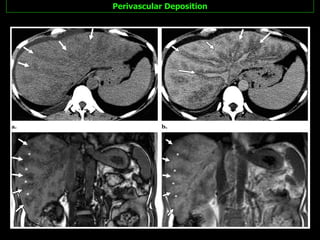 Perivascular Deposition 