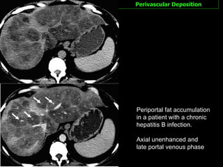 Perivascular Deposition Periportal fat accumulation in a patient with a chronic hepatitis B infection.  Axial unenhanced and late portal venous phase 
