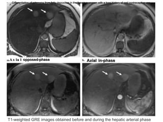 Periportal fat accumulation in a patient with a chronic hepatitis B infection.  Axial unenhanced and late portal venous phase Axial  opposed-phase Axial   in-phase Differentiation of adenoma from fatty deposition in the liver in a woman with a long history of oral contraceptive use. T1-weighted GRE images obtained before and during the hepatic arterial phase 