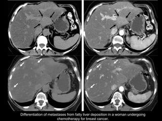 Differentiation of metastases from fatty liver deposition in a woman undergoing chemotherapy for breast cancer. 
