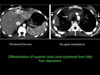 the upper mediastinum The level of the liver Differentiation of superior vena cava syndrome from fatty liver deposition. 
