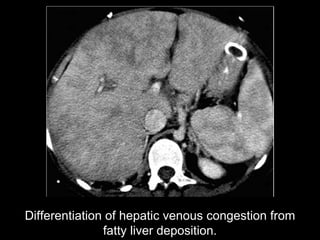 Differentiation of hepatic venous congestion from fatty liver deposition. 