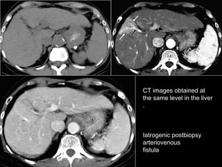 CT images obtained at the same level in the liver.  Iatrogenic postbiopsy arteriovenous fistula 