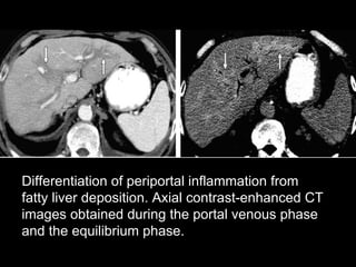 Differentiation of periportal inflammation from fatty liver deposition. Axial contrast-enhanced CT images obtained during the portal venous phase and the equilibrium phase. 