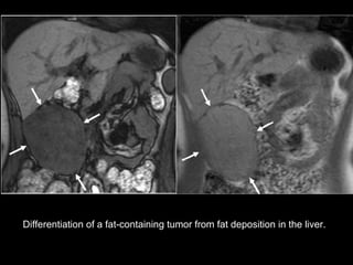 Differentiation of a fat-containing tumor from fat deposition in the liver. 