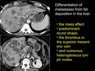 Differentiation of metastases from fat deposition in the liver. the mass effect predominant round shape,  the thrombus in the superior mesenteric vein and numerous heterogeneous lymph nodes 
