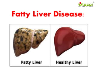 Fatty Liver Disease:
 