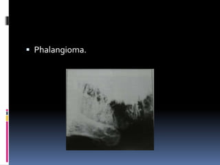  Phalangioma.
 