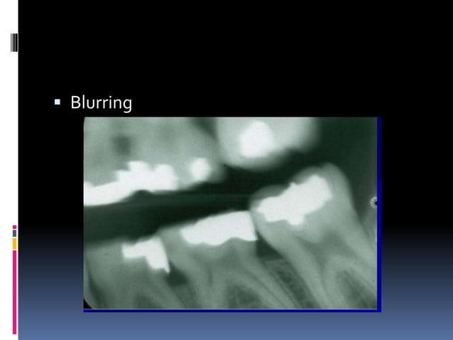 Faulty radiographs | PPTX | Dental Health | Diseases and Conditions