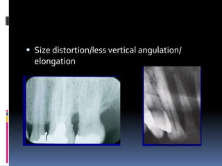  Size distortion/less vertical angulation/
elongation
 