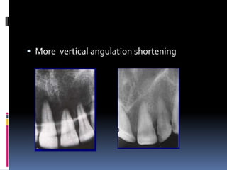  More vertical angulation shortening
 