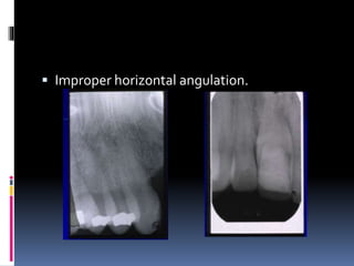  Improper horizontal angulation.
 