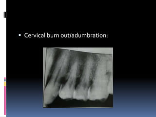  Cervical burn out/adumbration:
 