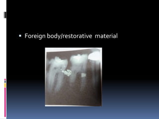  Foreign body/restorative material
 