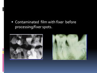 Contaminated film with fixer before
processing/fixer spots.
 