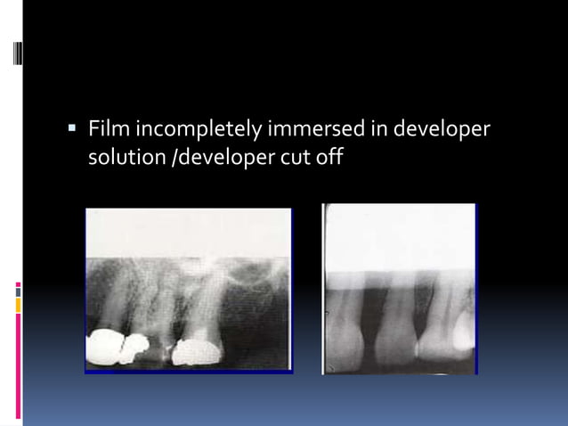 Faulty radiographs | PPTX | Dental Health | Diseases and Conditions