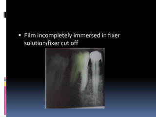  Film incompletely immersed in fixer
solution/fixer cut off
 