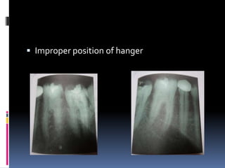  Improper position of hanger
 