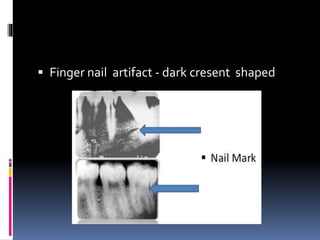  Finger nail artifact - dark cresent shaped
 