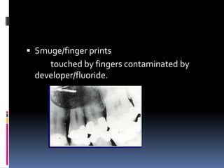  Smuge/finger prints
touched by fingers contaminated by
developer/fluoride.
 