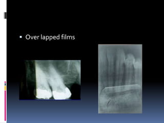  Over lapped films
 