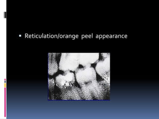  Reticulation/orange peel appearance
 