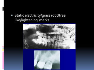  Static electricity/grass root/tree
like/lightening marks
 