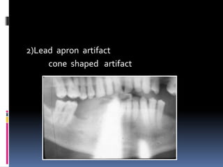 2)Lead apron artifact
cone shaped artifact
 