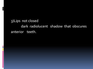 3)Lips not closed
dark radiolucent shadow that obscures
anterior teeth.
 