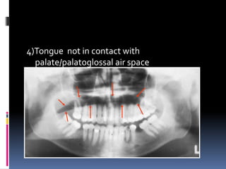 4)Tongue not in contact with
palate/palatoglossal air space
 