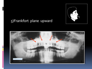5)Frankfort plane upward
R L
 
