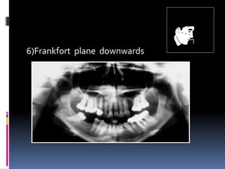 6)Frankfort plane downwards
 