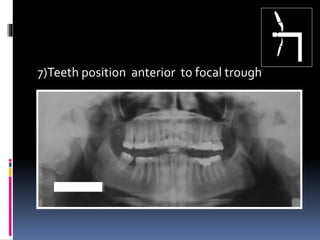 7)Teeth position anterior to focal trough
 